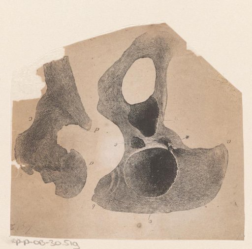 Human Bone with a Deformity