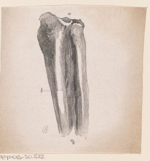 Human Bone with a Deformity