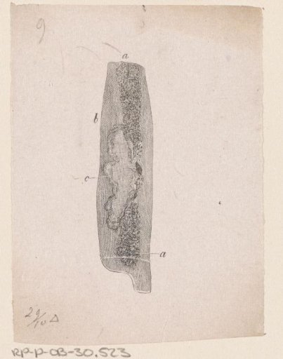 Human Bone with a Deformity