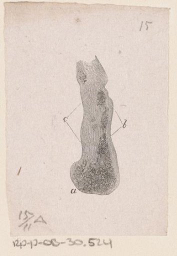 Human Bone with a Deformity
