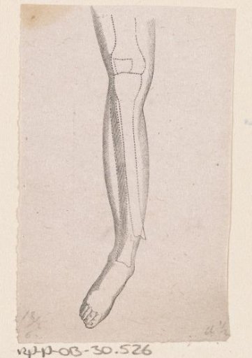 Human Lower Leg with a Fracture of the Bone