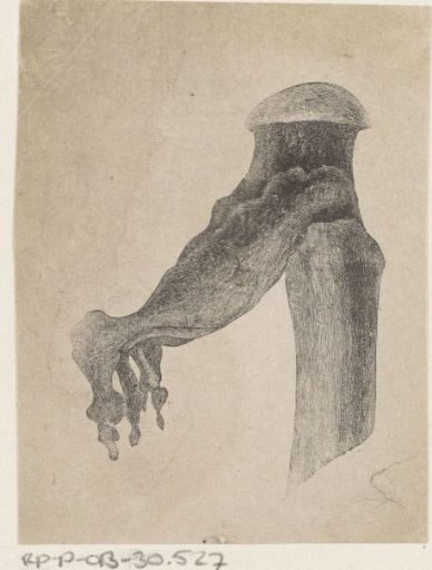 Human Bone with a Deformity