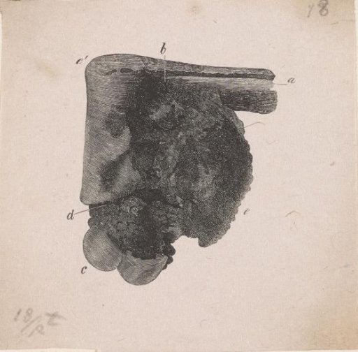 Human Bone with a Deformity