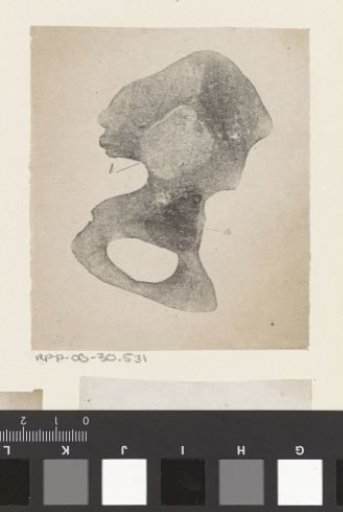 Human Bone with a Deformity