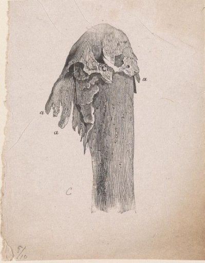 Human Bone with a Deformity