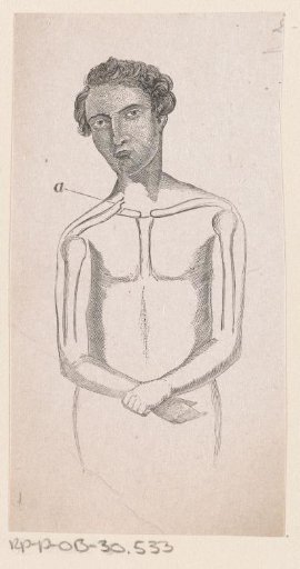 Man with a Fracture of the Collarbone