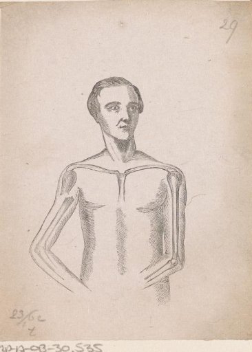 Man with a Fracture of the Right Upper Arm