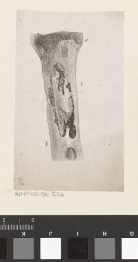 Human Bone with a Deformity