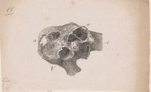 Human bone with a deformity