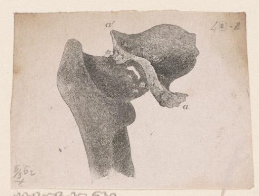 Human bone with a deformity