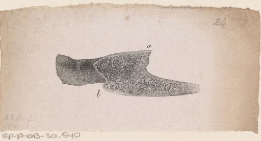 Human bone with a deformity