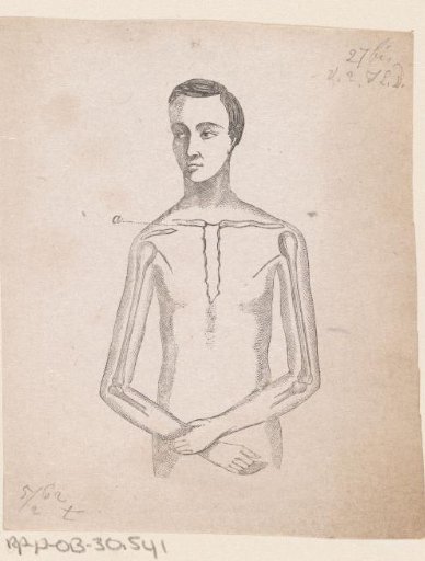 Man with a fracture of the collarbone