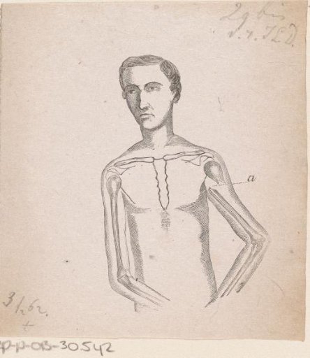 Man with a fracture of the left upper arm