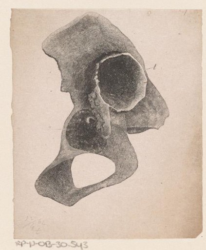 Human bone with a deformity