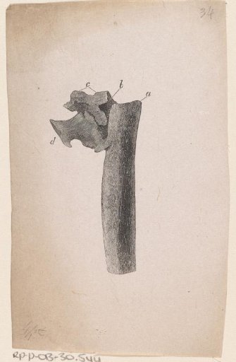 Human bone with a deformity