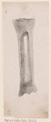 Human bone with a deformity