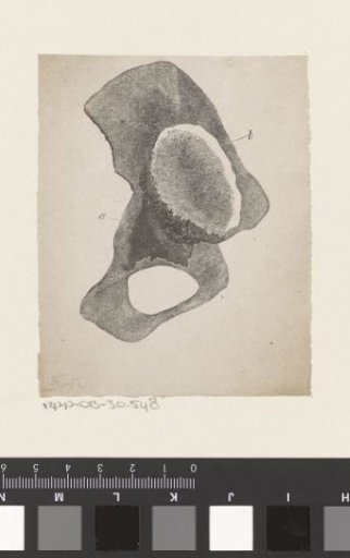 Human bone with a deformity