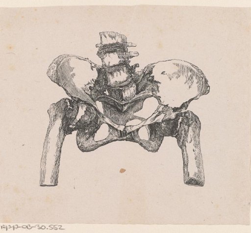 Human pelvis with a deformity