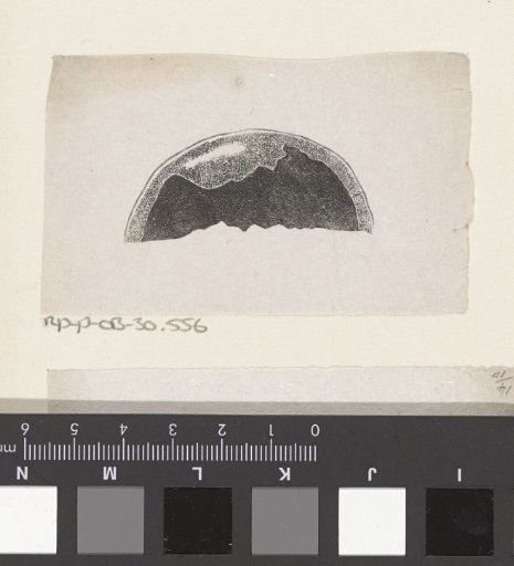 Human skull with a deformity