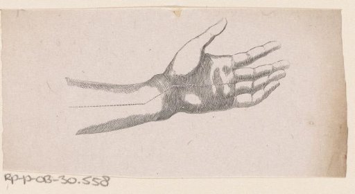 Human wrist with a fracture of the bone