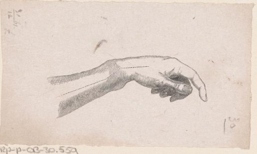 Human wrist with a fracture of the bone