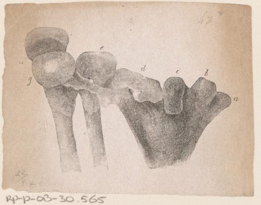 Human bone with a deformity