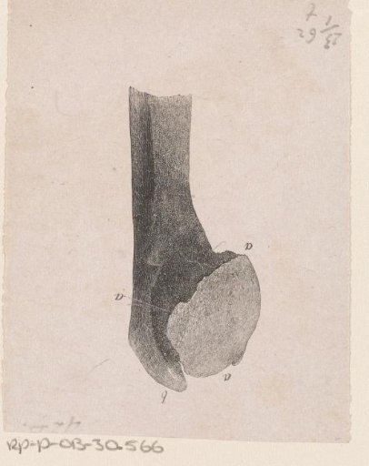 Human bone with a deformity