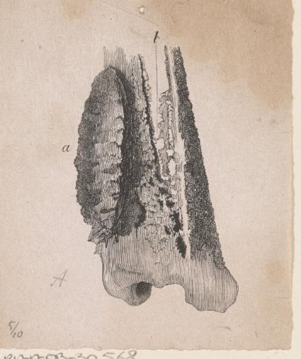 Human bone with a deformity