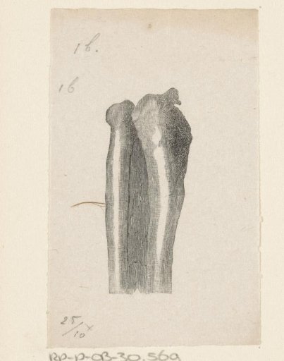 Human bone with a deformity