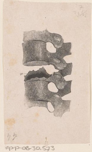 Human spine with a deformity