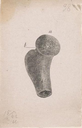 Human bone with a deformity
