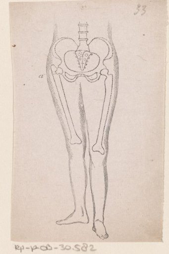 Human pelvis with a fracture in the bone
