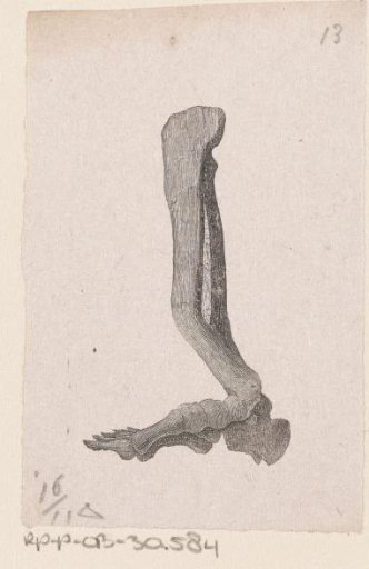 Human bone with a deformity