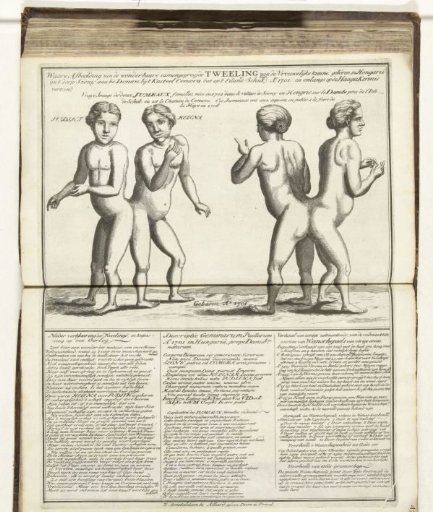 Conjoined twins from Hungary, Judith and Helena