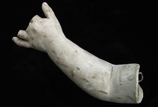 Cast of an Unidentified Child's Left Hand and Forearm (three middlefingers missing)