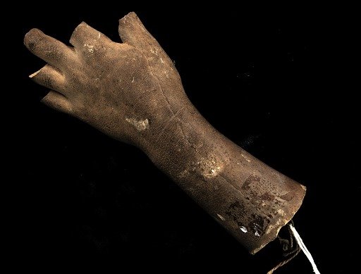Cast of an Unidentified Child's Left Hand and Forearm (all fingers missing)