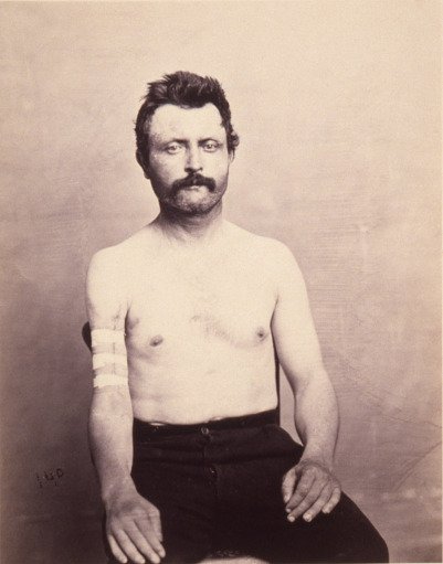 Private John Kelly, Successful Primary Excision of Four inches of the Upper Third of the Shaft of the Right Humerus for Gunshot Fracture, from the Photographic Catalogue of the Surgical Section