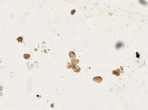 Paragonimus westermani