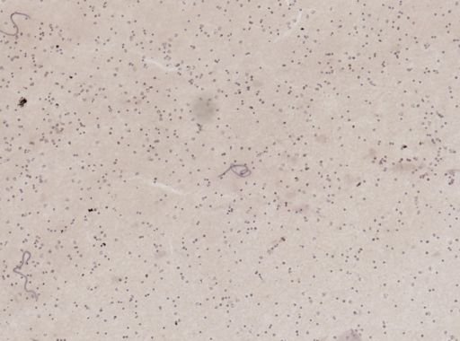 Wuchereria bancrofti