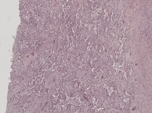 Entamoeba histolytica
