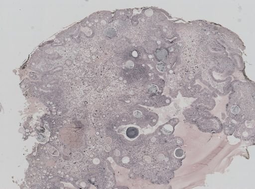 Rhinosporidium seeberi