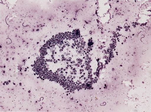 Onchocerca volvulus