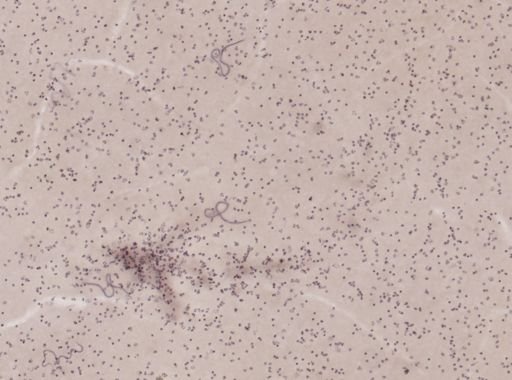 Wuchereria bancrofti