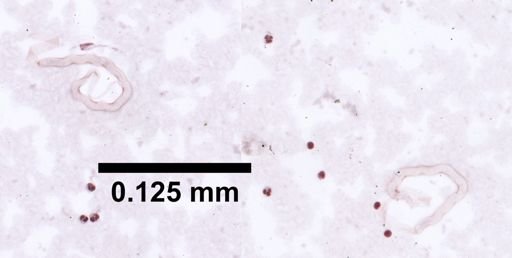 Wuchereria bancrofti