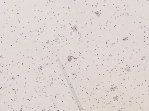 Wuchereria bancrofti