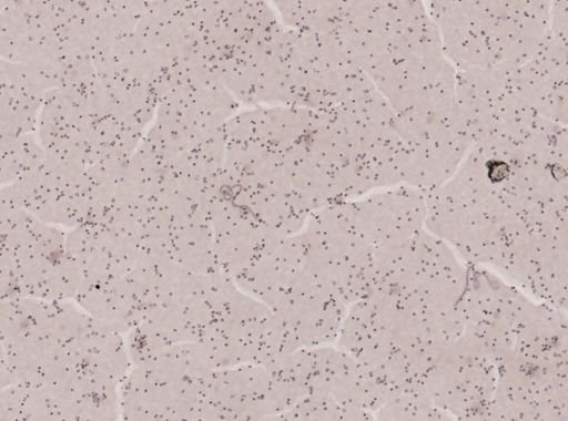 Wuchereria bancrofti