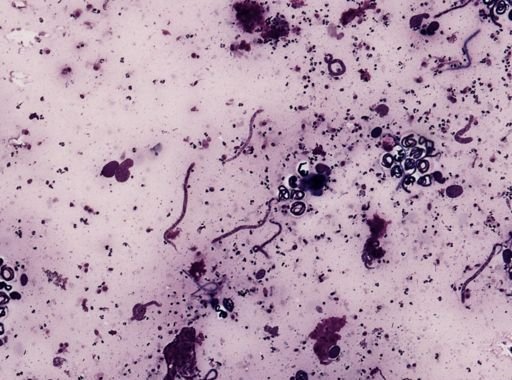 Onchocerca volvulus