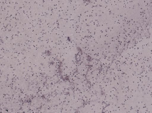 Wuchereria bancrofti