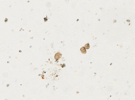 Paragonimus westermani
