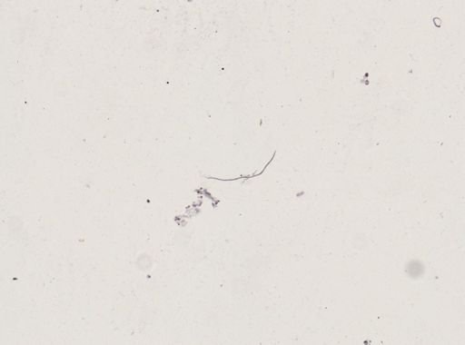 Onchocerca volvulus